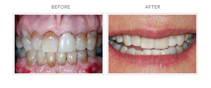 before and after whitening